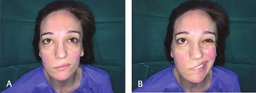Facial Nerve Reconstruction with Free Vascularized Composite Nerve Flap  from Intrapetrous Portion to Terminal Branches—Case Re
