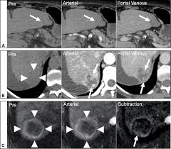 We are a proud training organization for institutes such as the university of toronto. Up To Date Role Of Ct And Mri In Hepatocellular Carcinoma Jhc