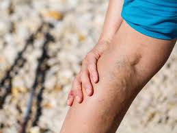 Scroll down to learn how to permanently pop your veins by building muscle and reducing water retention. Varicose Veins During Pregnancy Babycenter