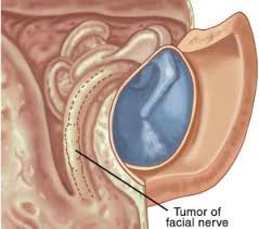 Image result for Glomus tumor