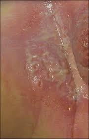 Use the baby rash pictures and descriptions below to compare with your baby's skin and see if you recognise what could be affecting them. Infant With Diaper Rash And White Bumps Photo Quiz American Family Physician
