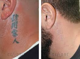 Keloid formation at the site of a tattoo. 45 Laser Tattoo Removal Before And After Reddit 2020