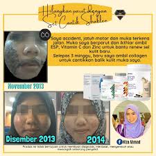 Anda ada masalah parut di muka? Hilangkan Parut Di Muka Dengan Set Kecantikan Shaklee Shima Jelani Pengedar Shaklee Shah Alam