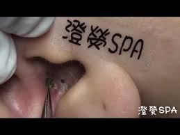 黑頭粉刺來了 youtube 角栓