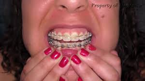 Braces Fetish - Porn Video Clips For Sale at iWantClips - Page 9