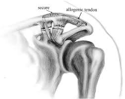 It reduces wear and tear. Treatment Of Ac Dislocation By Reconstructing Cc And Ac Ligaments With Allogenic Tendons Compared With Hook Plates Journal Of Orthopaedic Surgery And Research Full Text