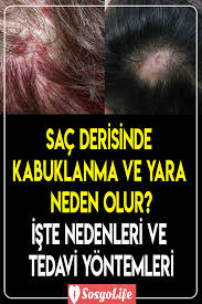 Sac Derisinde Kabuklanma Ve Yara Neden Olur Deri Sac Dogal Sac Bakimi