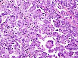 We did not find results for: Malignant Pleural Mesothelioma Epithelioid Type Download Scientific Diagram
