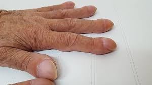 Image result for Clubbing nails feet