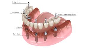 All On 6 Dental Implants Cost Mexico By Dr Jose Moguel Dds