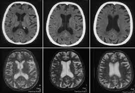 Marklagerveranderungen Bei Neurodegenerativen Und Vaskularen Demenzerkrankungen Springerlink