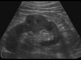 Dromedary camels are the tallest. Urinary Tract And Male Reproductive System 2 1 Kidney And Ureter Case 2 1 2 Benign Renal Tumors Ultrasound Cases