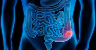 نحوه-گرفتن-معافیت-پزشکی-روده