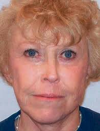 Face-lifts are down, but not