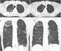 Treatment For Mycobacterium Avium Complex Lung Disease Sciencedirect