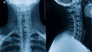 Surface anatomy of the brainstem. Cervical Rib Anatomy Location And Treatment