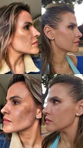 Tratamiento de Melasma con Skin Boster. Con la @dra.analia_corvalan