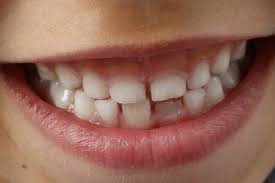The varnish will start to wear away when you brush your teeth and will be completely gone within a few days. New Study Questions Value Of Fluoride Varnish