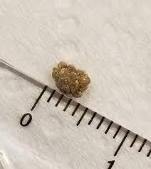 It S Out The Symptoms Started January 1 What A Way To End The Month Kidneystones
