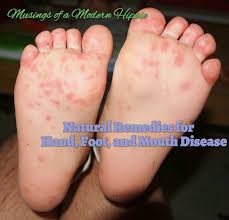 Natural Support For Hand Foot And Mouth Disease Hand Foot And Mouth Hand And Mouth Disease Natural Remedies