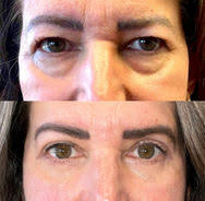 Denver's Eyelid Surgery Specialist