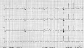 9,71,72 elevated troponin levels have proven to be a more reliable predictor of myocardial injury than levels of creatine kinase. Ecg Interpretation