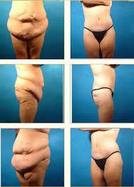 Lower Body Lift Dr Lomonaco Plastic Surgery Houston Tx