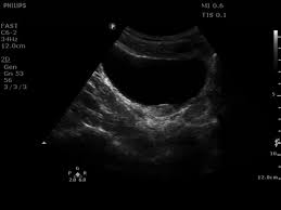 Choosing Wisely Ultrasound For Suspected Nephrolithiasis Tpa