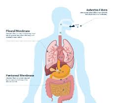 Surgery, radiation and chemotherapy treatments. What Are The Symptoms Of Mesothelioma Quora