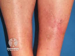Image result for allergy rash on the legs