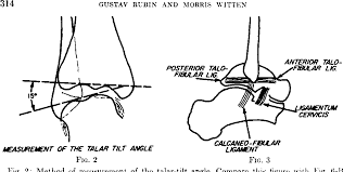 Image result for Talar Tilt