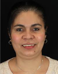 Zirconia Implants London, Exclusive Technology