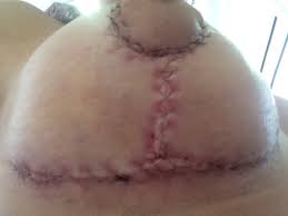 More images for redness around stitches » Why Am I Red Crazy Itchy Where Dissolvable Stitches Are Near Incision Site After Breast Lift Photos