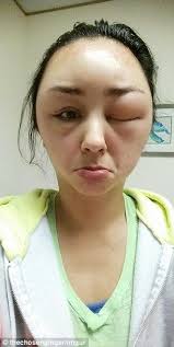 Woman Documents Scary Allergic Reaction To Hair Dye In Dramatic Images Dyed Hair Your Hair Hair