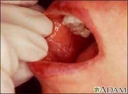 Mouth Ulcers Information Mount Sinai New York