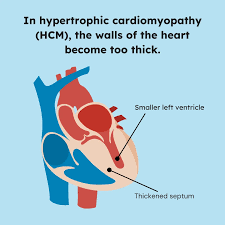 Image result for Cardiomyopathy