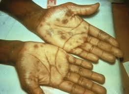 Image result for Secondary Syphilis