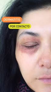 Image result for dermatitis contacta toxica