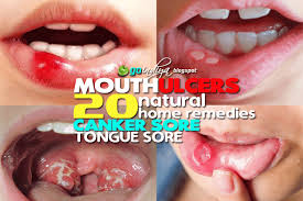 Mouth Ulcers Canker Sore Tongue Sore 20 Best Home Remedies For Fast Relief Natural Home Remedies Simple An Ulcer Remedies Mouth Canker Sore Mouth Ulcers