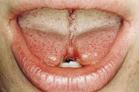 When can i change my tongue piercing? Oral Piercing Dental Complications Vital