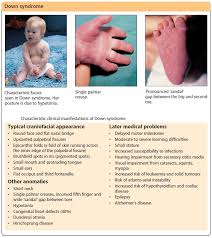 It is also seen in some native american peoples and occasionally in europeans (e.g., scandinavians. Characteristic Clinical Manifestations Of Down Syndrome Grepmed