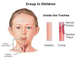 Image result for Croup