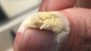 A boil (also called a furuncle) is a common type of infection that occurs in a hair follicle. What Is It Cyst Wart Ingrown Hair Infected Boil Youtube