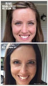 Rodan Fields skincare product results