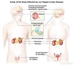 It is important to note that the signs of kidney cancer are shared by many other benign (noncancerous) conditions. Hereditary Syndromes Associated With Kidney Cancer Renal Cell Cancer Pdq Genetics Patient Information Nci Michigan Medicine