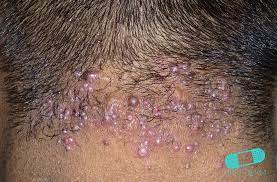 Cysts grow slowly and usually don't hurt, but sometimes they can get swollen and painful and may ooze a thick fluid with a bad smell. 10 Most Common Black Skin Conditions And Their Treatment First Derm
