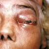 La mucormicosis cutánea primaria es una infección micótica rara que se asocia a estados de inmunosupresión. Https Encrypted Tbn0 Gstatic Com Images Q Tbn And9gctmcy10syptqx Mzvdgto4shppbdrkqsbvyy7mo9mmexx3eq1om Usqp Cau
