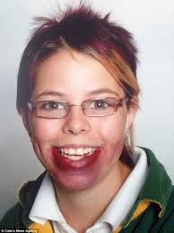 Tasmanian woman Tamara Bennett whose lips will never stop growing due to  rare condition