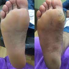 Rasa tak selesa dan malu nak pakai selipar.. Tumit Merekah Kembali Cantik Curio Spa