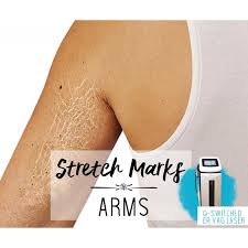 Stretch marks can be removed using laser treatment, such as resurfx fractional laser and intense pulsed light (ipl) photorejuvenation another great option for laser stretch mark removal is the resurfx fractional laser. Treatment Voucher Stretch Marks Removal Arms With Er Q Switched Yag Laser
